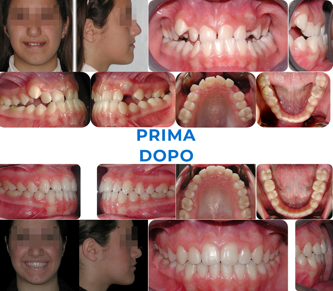 Ortodonzia invisibile