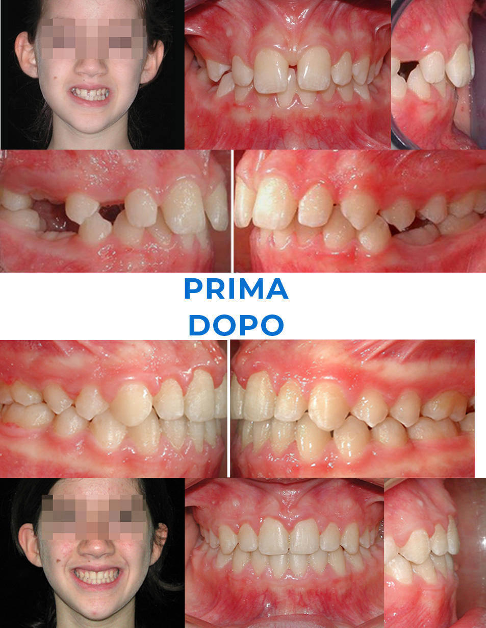 Ortodonzia invisibile