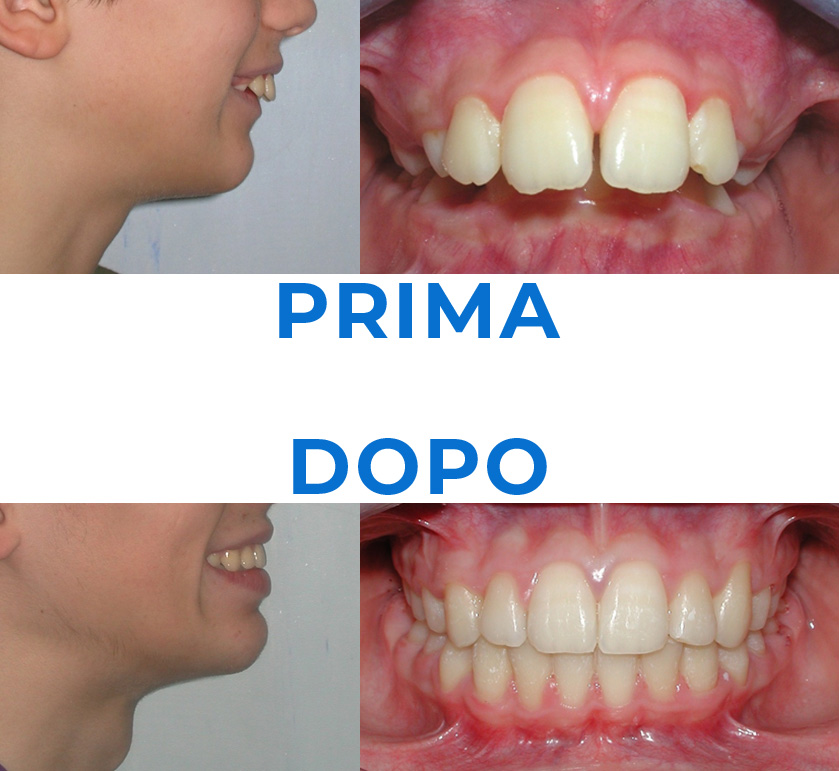 Ortodonzia invisibile