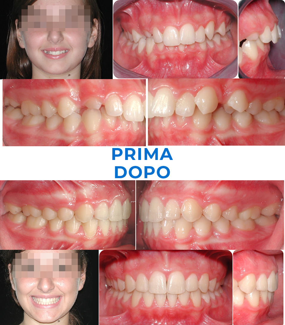Ortodonzia invisibile