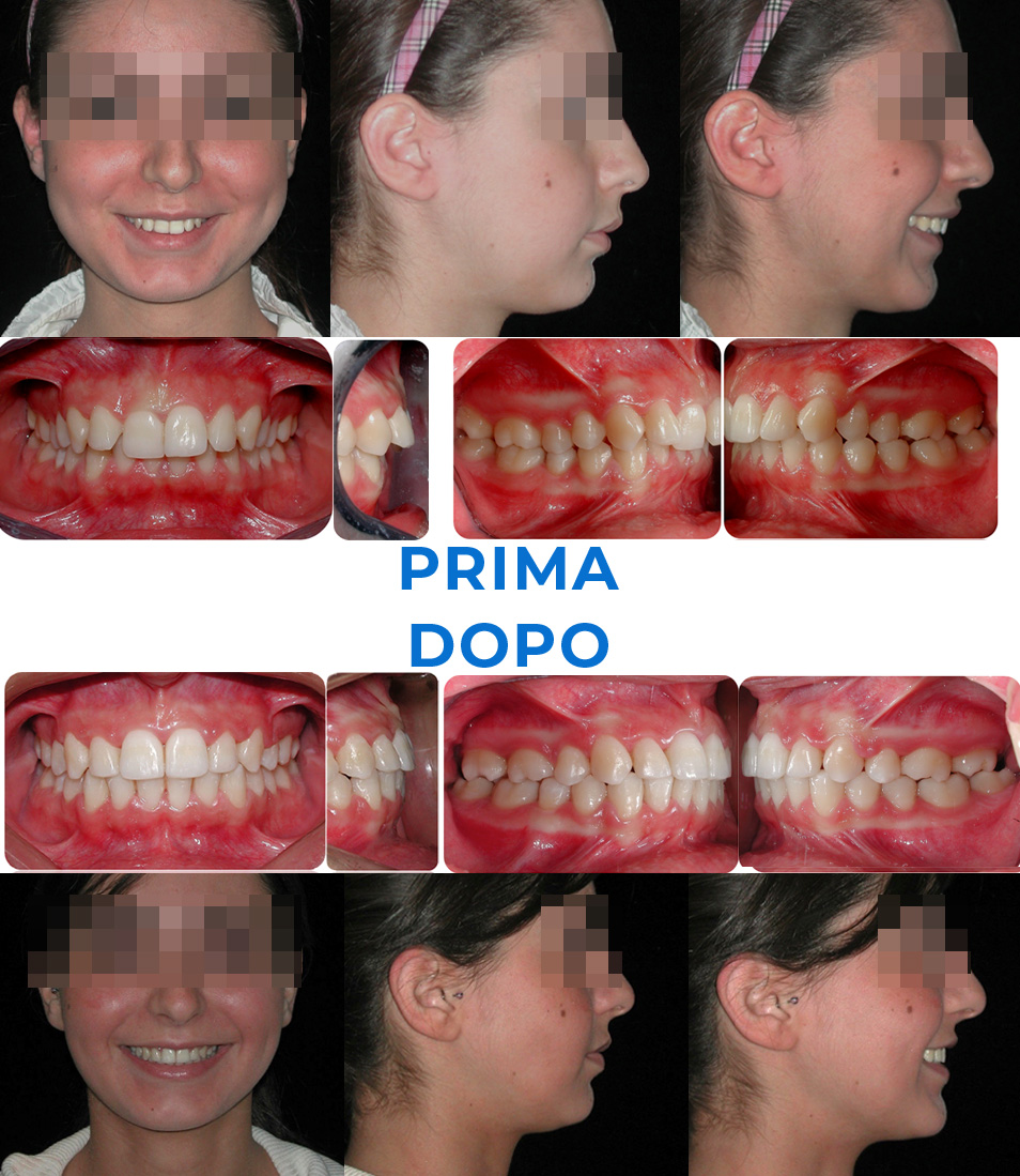 Ortodonzia invisibile