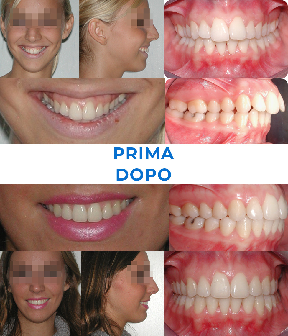 Ortodonzia invisibile