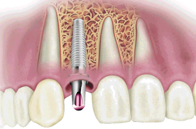 Cos'è l'Implantologia dentale?