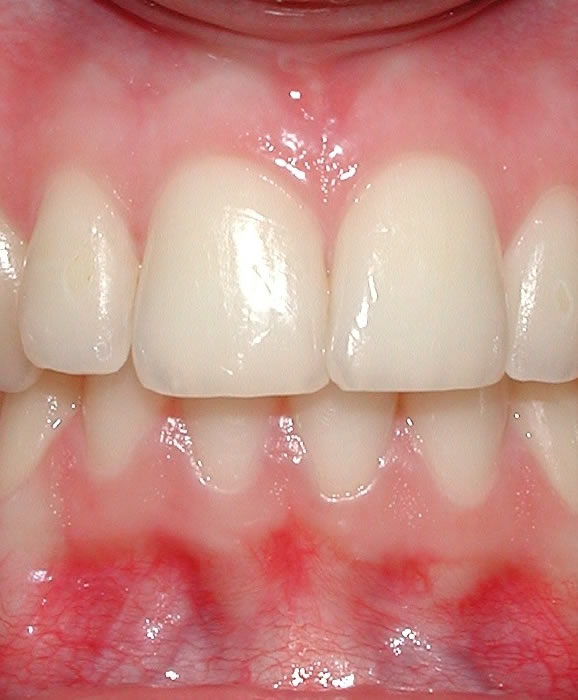 Occlusione