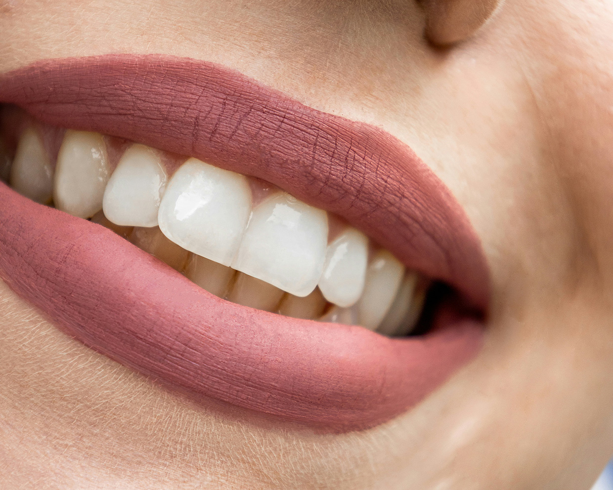 Faccette dentali effetto naturale: cosa significa davvero