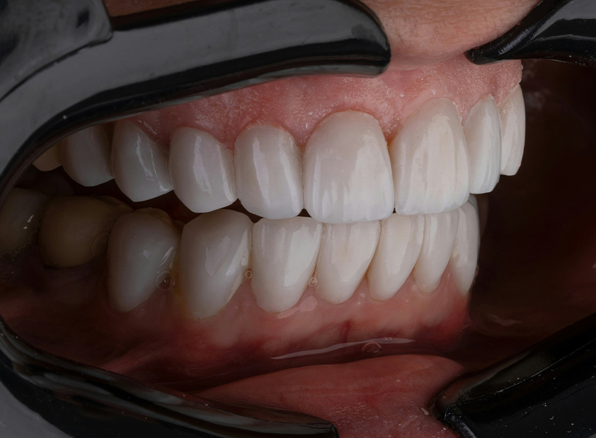 Quanto dura un impianto dentale davvero?